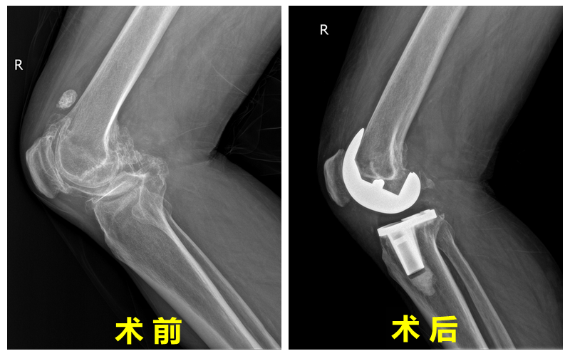 手術(shù)對(duì)比照.png