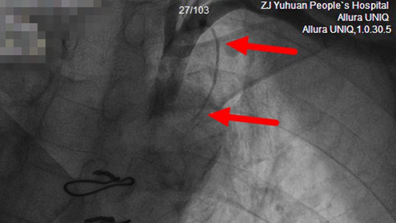 C:\Users\admin\Desktop\20230410心內(nèi)科搭橋搶救\王熙平 冠脈手術(shù)截圖 左側(cè)內(nèi)乳動脈纖細(xì) 遠(yuǎn)端完全閉塞.jpg