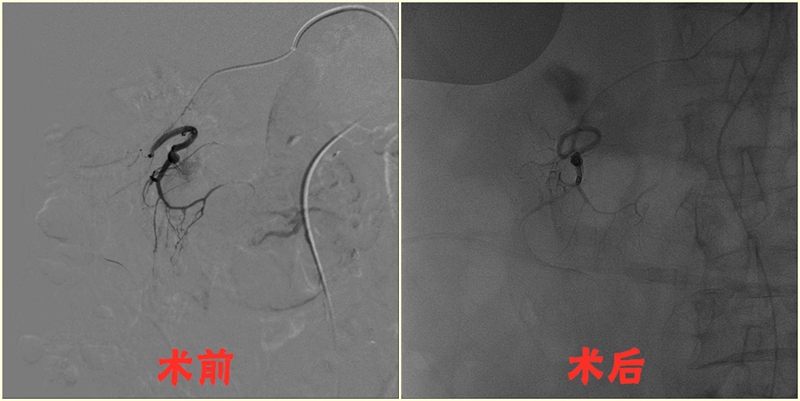 胰十二指腸動(dòng)脈瘤栓塞術(shù)0_副本_副本.jpg