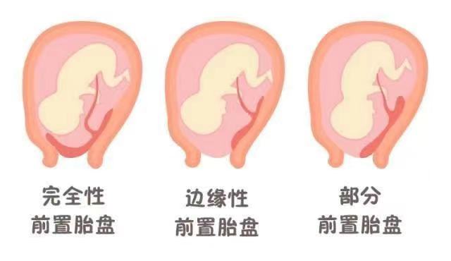 C:\Users\admin\Desktop\20230203帆狀胎盤血管前置\efd6c07b943e5dafb9b079023d95942.jpg