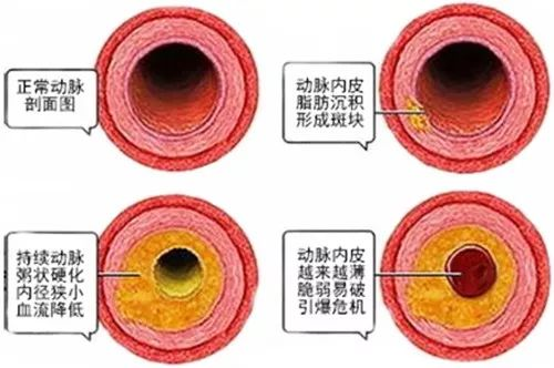 動脈硬化.png